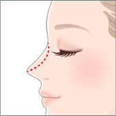 隆鼻術シリコンプロテーゼ