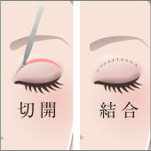 切開法