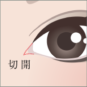 目頭切開
