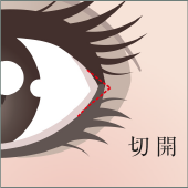目尻切開
