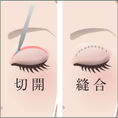 眼まぶた下垂(切開)