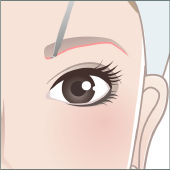 眉下切開