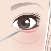 下まぶたたるみ取り