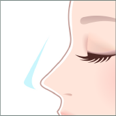 プロテーゼ抜去